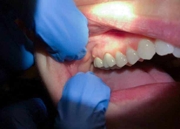 Best Tooth Infection Emergency Dentist  in Woodbine, NJ